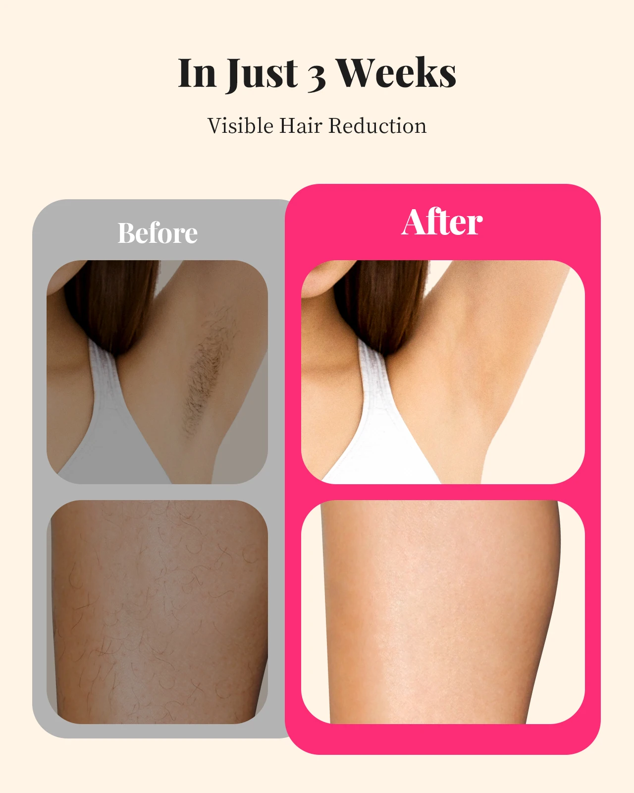990,000‑Flash IPL Hair Removal Device, 9 Energy Levels, 5.2 cm² Window - Image 6